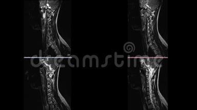 脑硬化微中风白斑的磁共振成像颈部